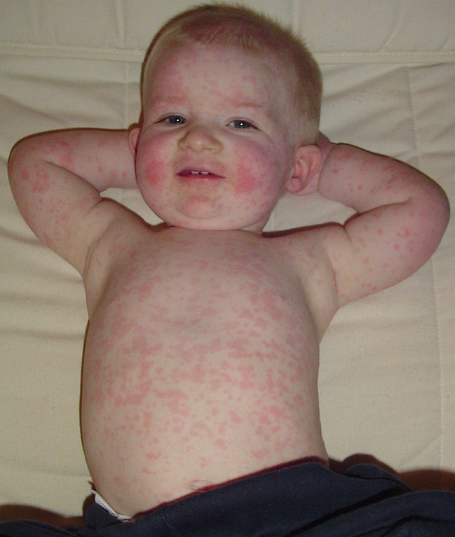 human papillomavirus infection baby)